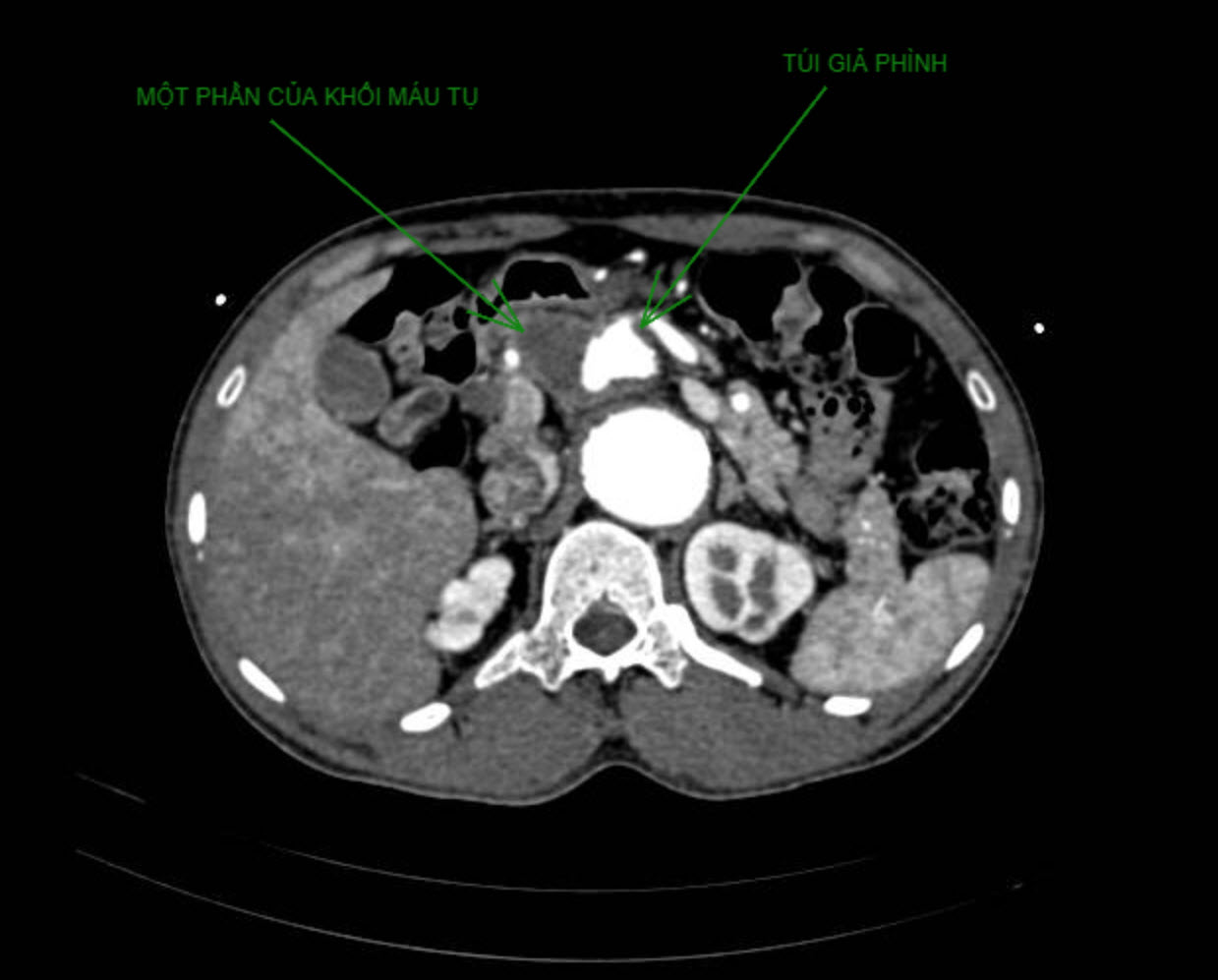 Hình  CT cho thấy khối giả phình và khối máu tụ của người bệnh trước can thiệp 2.jpg